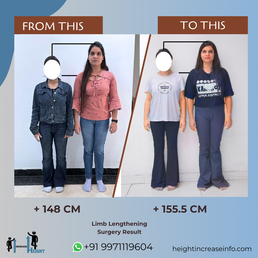 Limb Lengthening Result 1